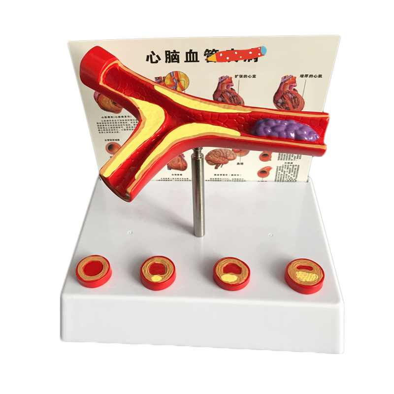 Medical Lab Supplies - 50-krotne powiększone ludzkie naczynie Atherosclerosis Model